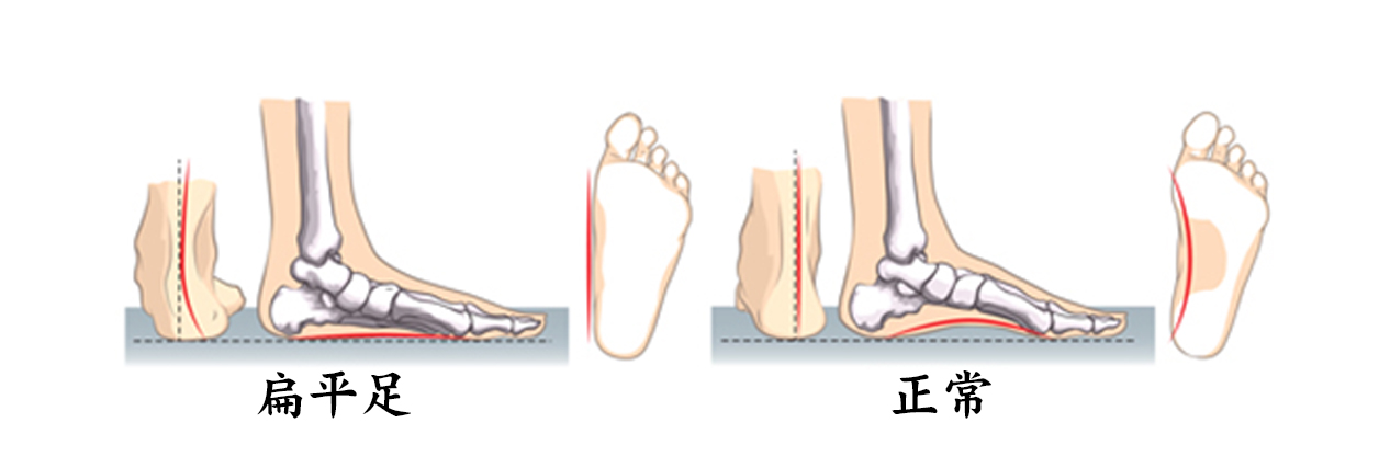 扁平足 へんぺいそく って何 第二わしざわ整形外科 ブログ