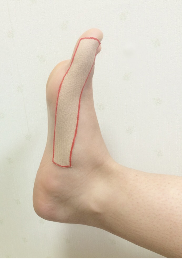 外反母趾に対するテーピング 第二わしざわ整形外科 ブログ