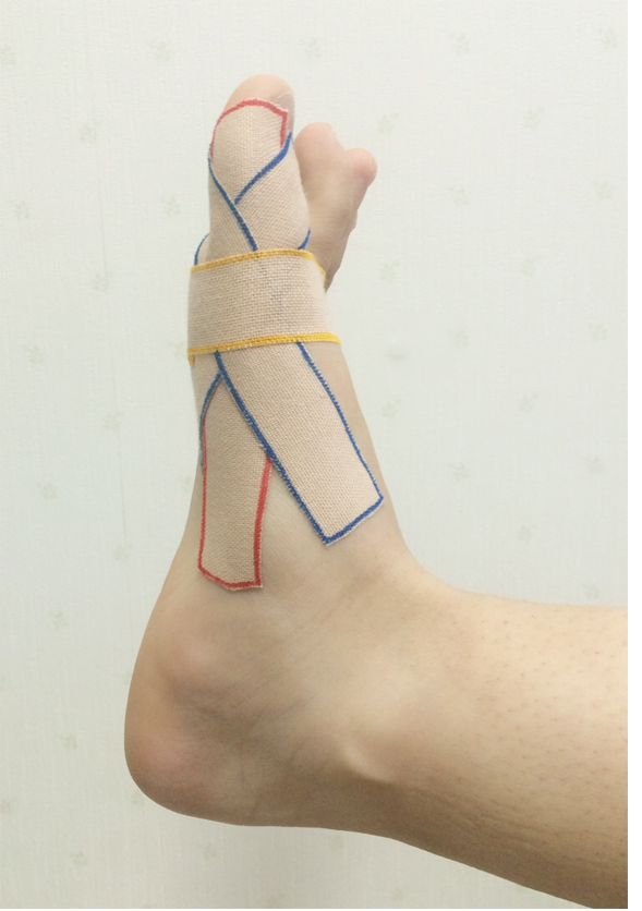 外反母趾に対するテーピング 第二わしざわ整形外科 ニュース