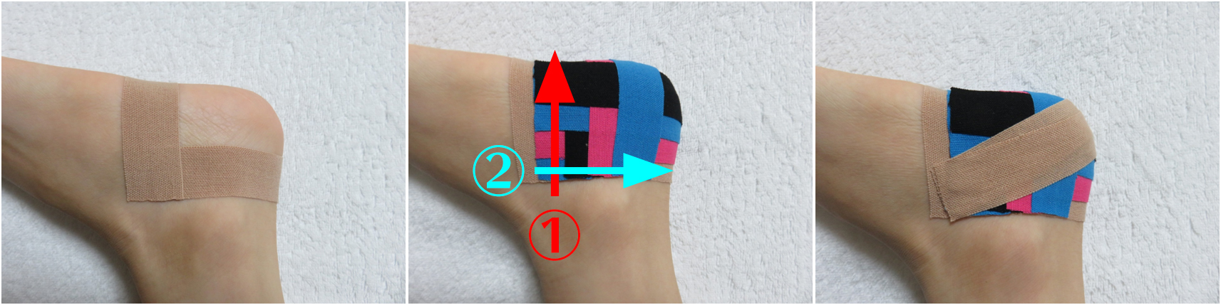 踵 かかと の痛みに対してのテーピング 第二わしざわ整形外科 ブログ